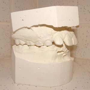 Puede incluir: Un molde dental de yeso de dientes superiores e inferiores. El molde blanquecino muestra la forma y disposición detallada de los dientes. El modelo es un bloque sólido con una sección removida para revelar los dientes.