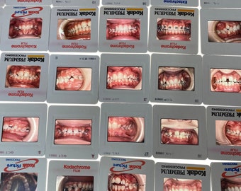 Dental 35mm slides - lot of 5 -old orthodontist dentist teeth films- teeth slide- Halloween vintage dental prop oddity dental