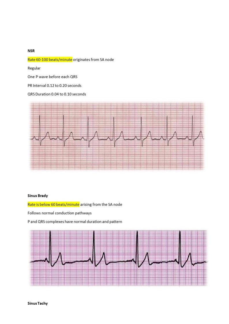 The Relias Dysrhythmia Basic B Practice | Questions and Verified ...