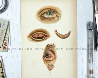 1900's Eye Irritation, Not Reproduction, Vintage Publication, Medical, Anatomy, Eye Diseases