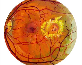 Arte de macroaneurisma retiniano: pintura acrílica sobre lienzo de 16 pulgadas sobre una afección ocular.