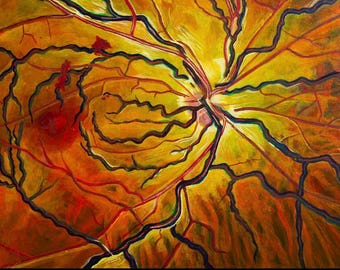 Venous Statis Retinopathy