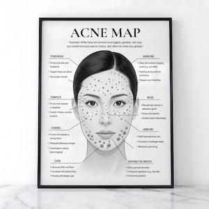 May include: A framed educational poster titled ACNE MAP featuring a grayscale illustration of a face with dots indicating acne zones. Text labels identify specific areas like forehead, hairline, temples, nose, cheeks, jawline, chin, and mouth.