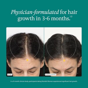 May include: Side-by-side images of a person's scalp, illustrating hair growth. The left image is labeled "BEFORE," and the right image is labeled "6 MONTHS GROWING." Text at the top reads "Physician-formulated for hair growth in 3-6 months."