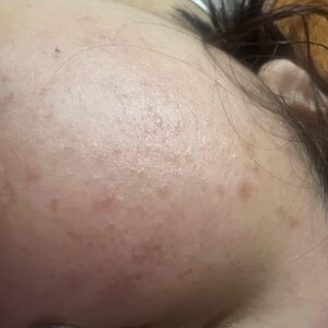 Pu&ograve; includere: Primo piano della fronte e di una parte del viso di una persona. La pelle ha un incarnato chiaro con diverse piccole macchie rossastre-marroni. I capelli scuri sono visibili sul lato del viso e sulla fronte.