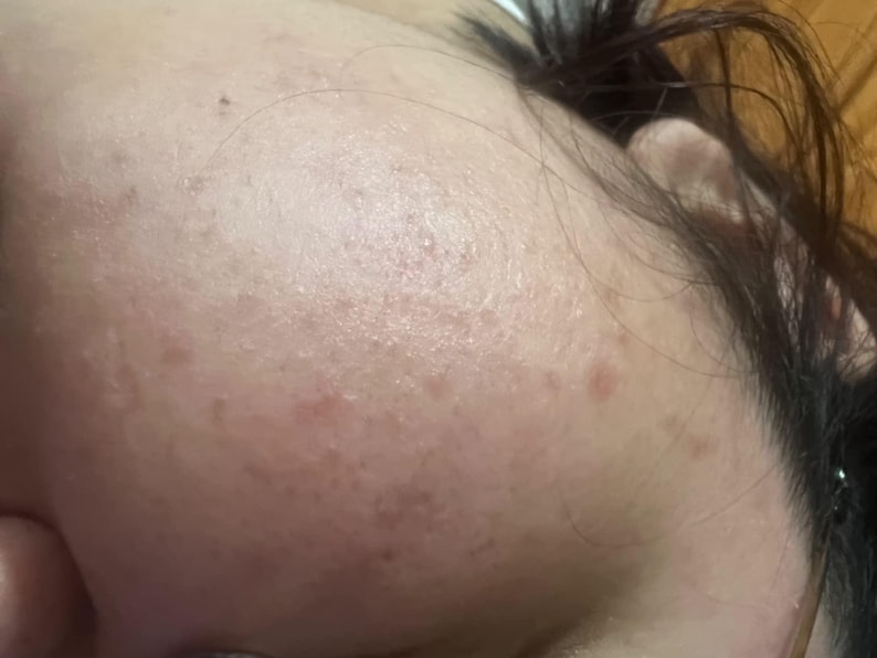 Pu&ograve; includere: Primo piano della fronte e di una parte del viso di una persona. La pelle ha un incarnato chiaro con diverse piccole macchie rossastre-marroni. I capelli scuri sono visibili sul lato del viso e sulla fronte.