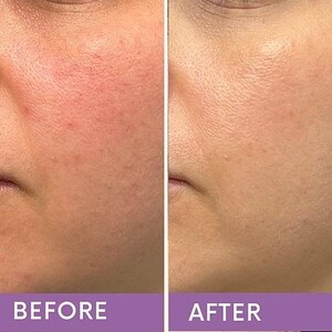 May include: A split-screen image showing a close-up of a person's face. The left side, labeled "BEFORE," displays skin with redness and imperfections. The right side, labeled "AFTER," shows improved skin tone and texture.