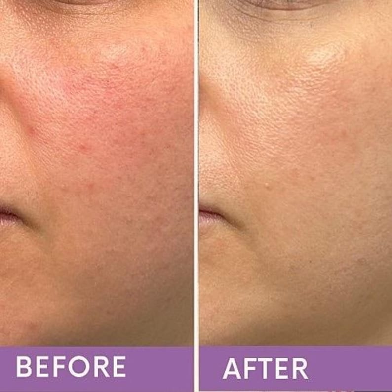May include: A split-screen image showing a close-up of a person's face. The left side, labeled "BEFORE," displays skin with redness and imperfections. The right side, labeled "AFTER," shows improved skin tone and texture.