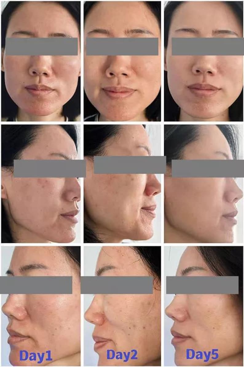 May include: A series of nine images showing a person's face from different angles. The images are arranged in a 3x3 grid, with the text "Day1", "Day2", and "Day5" at the bottom of the images. The person's eyes are covered by a gray bar.