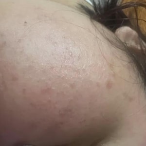 May include: Close-up of a person's forehead and part of their face. The skin has a light complexion with visible pores and small, reddish-brown spots. Dark hair is visible on the right side of the image.