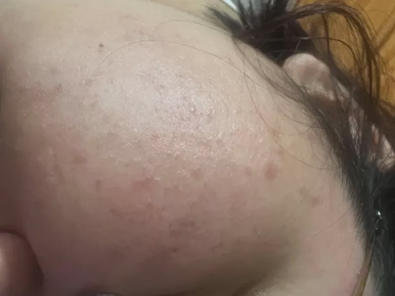 May include: Close-up of a person's forehead and part of their face. The skin has a light complexion with visible pores and small, reddish-brown spots. Dark hair is visible on the right side of the image.