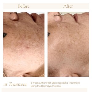 Puede incluir: Comparaci&oacute;n lado a lado de un rostro antes y despu&eacute;s de un tratamiento de microagujas. La imagen "Antes" muestra la piel con manchas, mientras que la imagen "Despu&eacute;s", tomada 3 semanas despu&eacute;s, muestra una tez m&aacute;s clara. El texto dice "1er Tratamiento" y "3 semanas despu&eacute;s del primer tratamiento de microagujas con el protocolo Dermalyn."