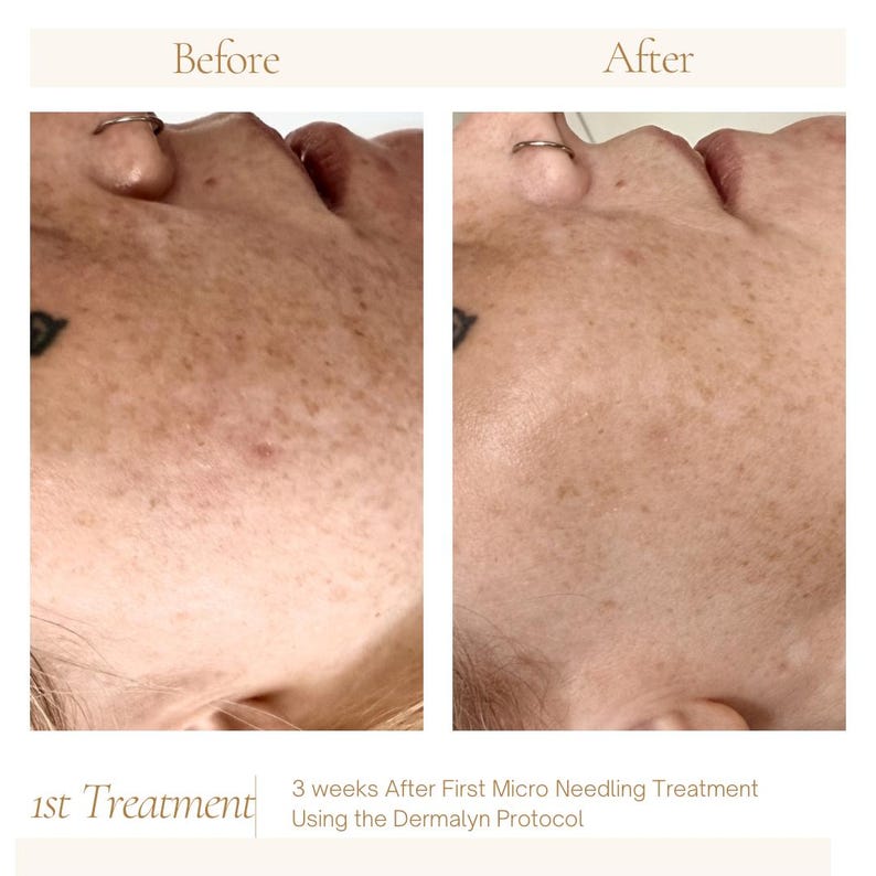 Puede incluir: Comparaci&oacute;n lado a lado de un rostro antes y despu&eacute;s de un tratamiento de microagujas. La imagen "Antes" muestra la piel con manchas, mientras que la imagen "Despu&eacute;s", tomada 3 semanas despu&eacute;s, muestra una tez m&aacute;s clara. El texto dice "1er Tratamiento" y "3 semanas despu&eacute;s del primer tratamiento de microagujas con el protocolo Dermalyn."