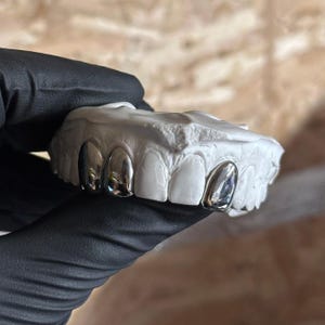 May include: A dental mould featuring silver-coloured tooth caps. The caps are highly polished and reflect light, contrasting with the white mould. The image is a close-up, highlighting the detail of the dental work.