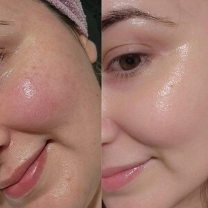 May include: A split-screen comparison showing a close-up of a cheek with visible redness and texture on the left, contrasted with a smoother, hydrated, and glowing complexion on the right, highlighting the visible effects of a skincare product.