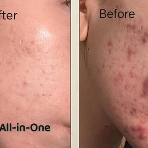 May include: Side-by-side comparison of a person's face, showing the skin's condition before and after treatment. The left side, labeled "After," shows improved skin texture. The right side, labeled "Before," shows skin with acne. The text "lifecell All-in-One" is at the bottom.
