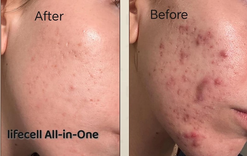 May include: Side-by-side comparison of a person's face, showing the skin's condition before and after treatment. The left side, labeled "After," shows improved skin texture. The right side, labeled "Before," shows skin with acne. The text "lifecell All-in-One" is at the bottom.
