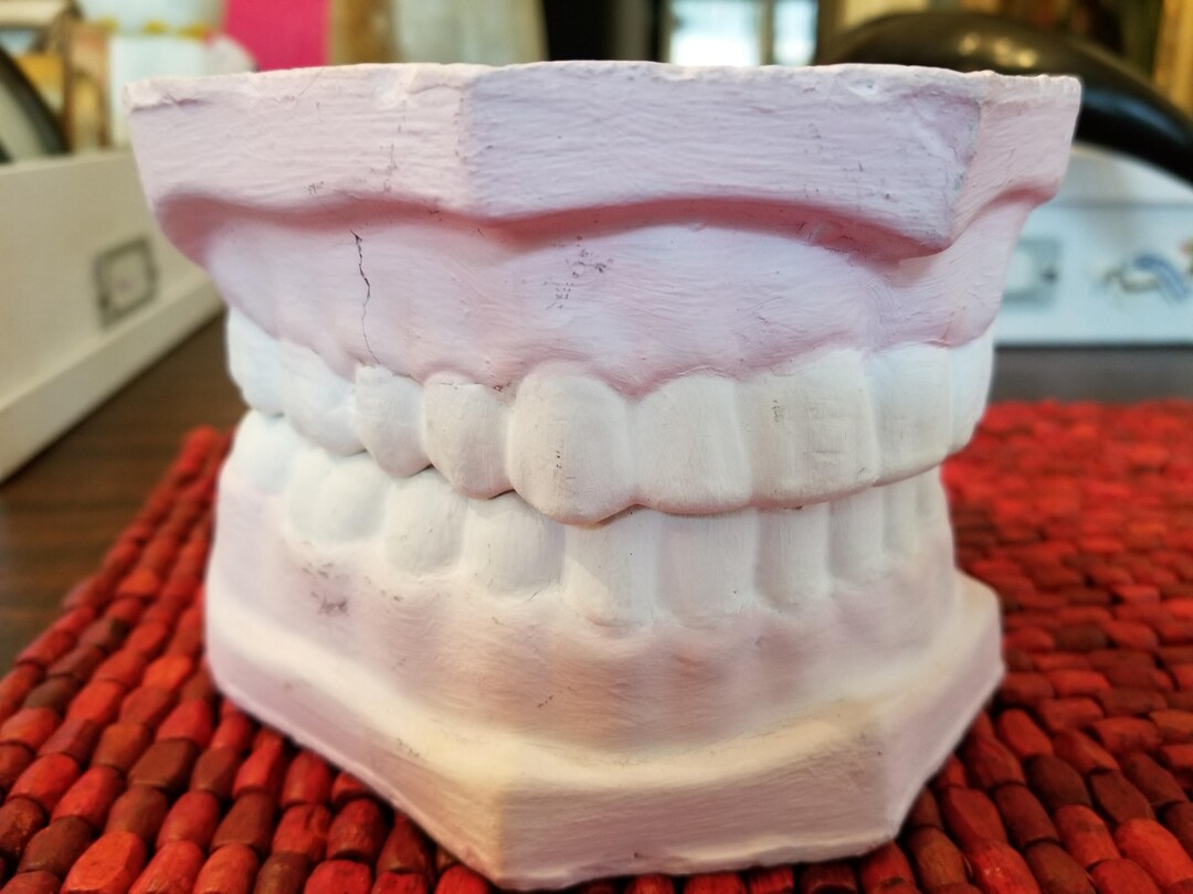 Antique 1960's Orthodontist Dental Teaching Chalk Model With Teeth
