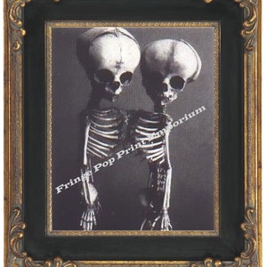 Victorian Siamese Twins Skeleton Art Print 8 x 10 - Anatomical Medical Oddity