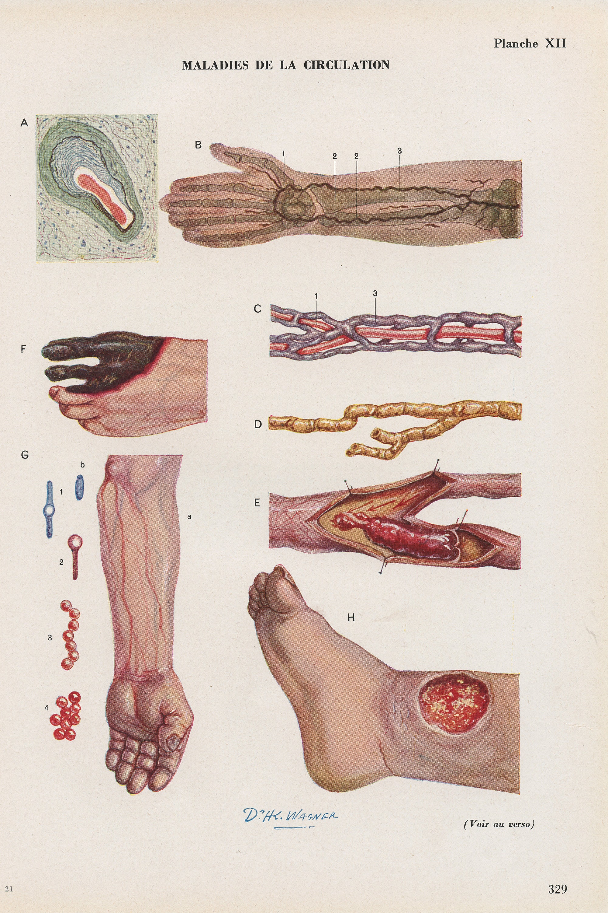 Gravure Médicale de Circulation Sanguine Vintage 1962. Illustration Médicale. Décoration Cabinet Cad