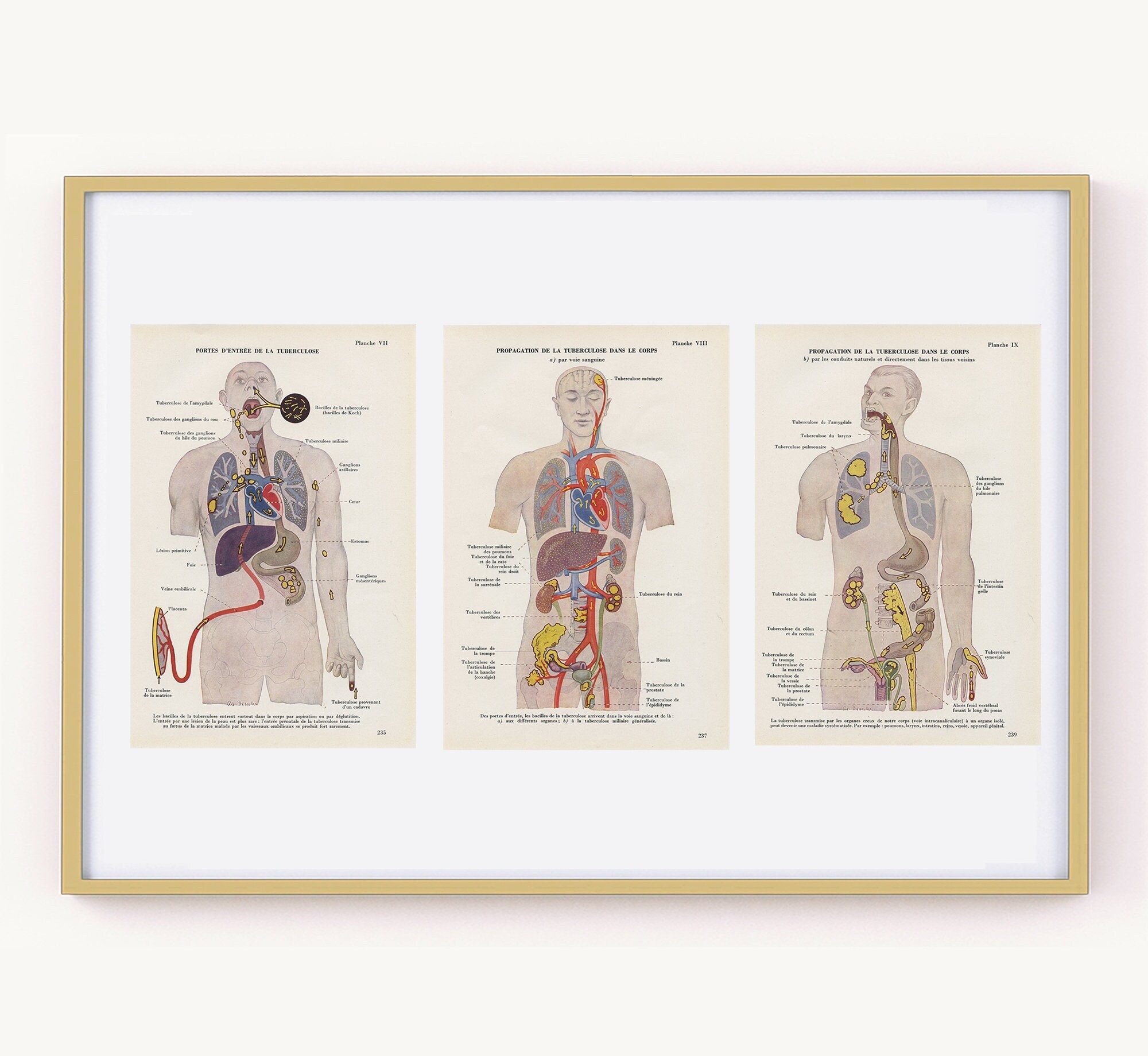 Lot de 3 Illustrations Anatomiques Tuberculose 1952 Vintage. Déco Médicale Cadeau Pour Médecin Pneum