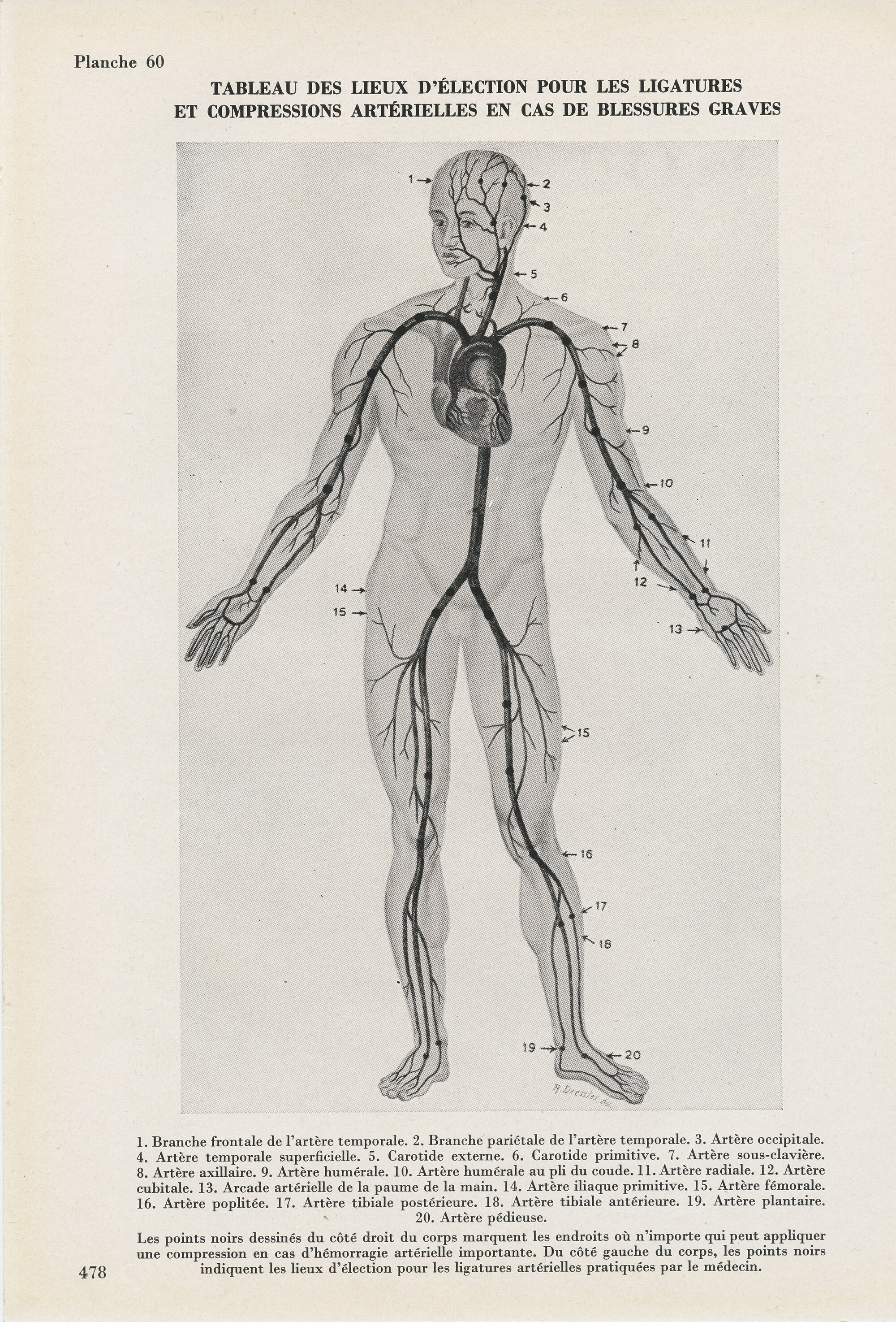Gravure d'anatomie Vintage de 1950 Ligatures & Garrots. Illustration Médicale Anatomique. Décoration