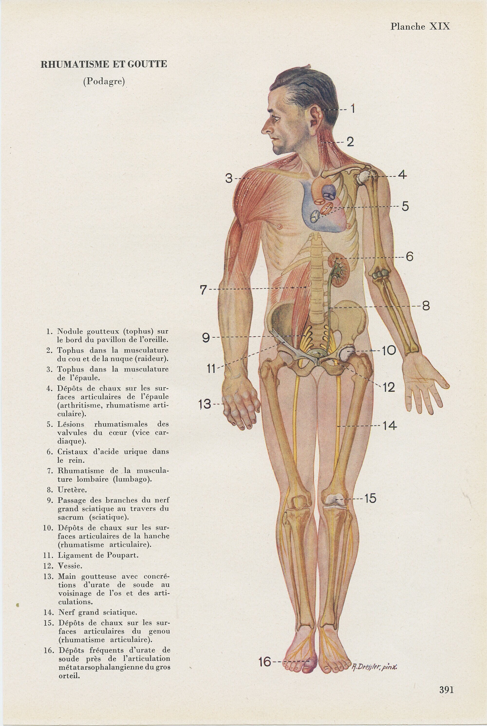Petite Affiche Médicale de Rhumatisme et Goutte Vintage 1962. Illustration Décoration Cabinet Cadeau