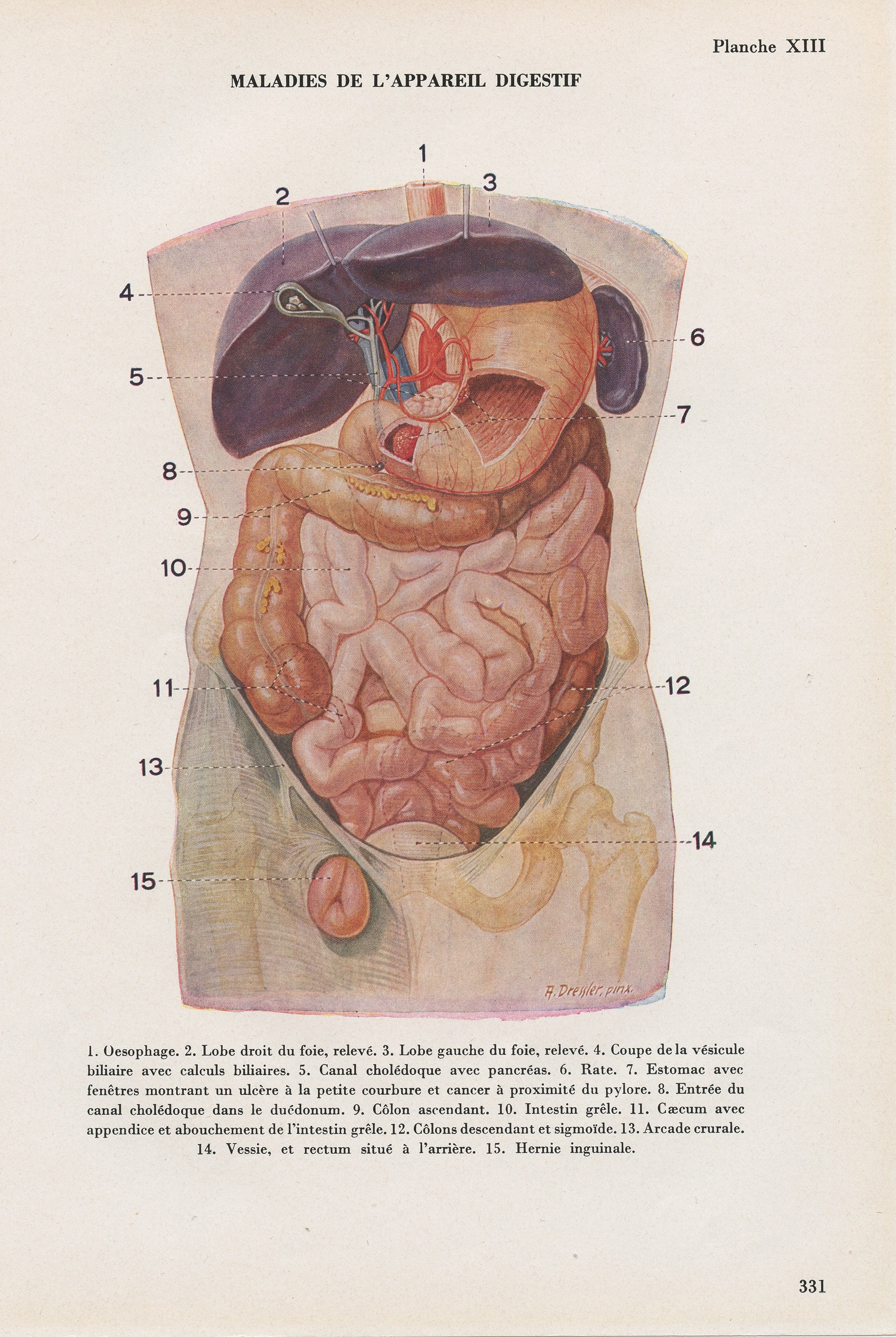 Gravure Médicale Des Maladies de L'appareil Digestif Vintage 1962. Illustration Médicale. Décoration