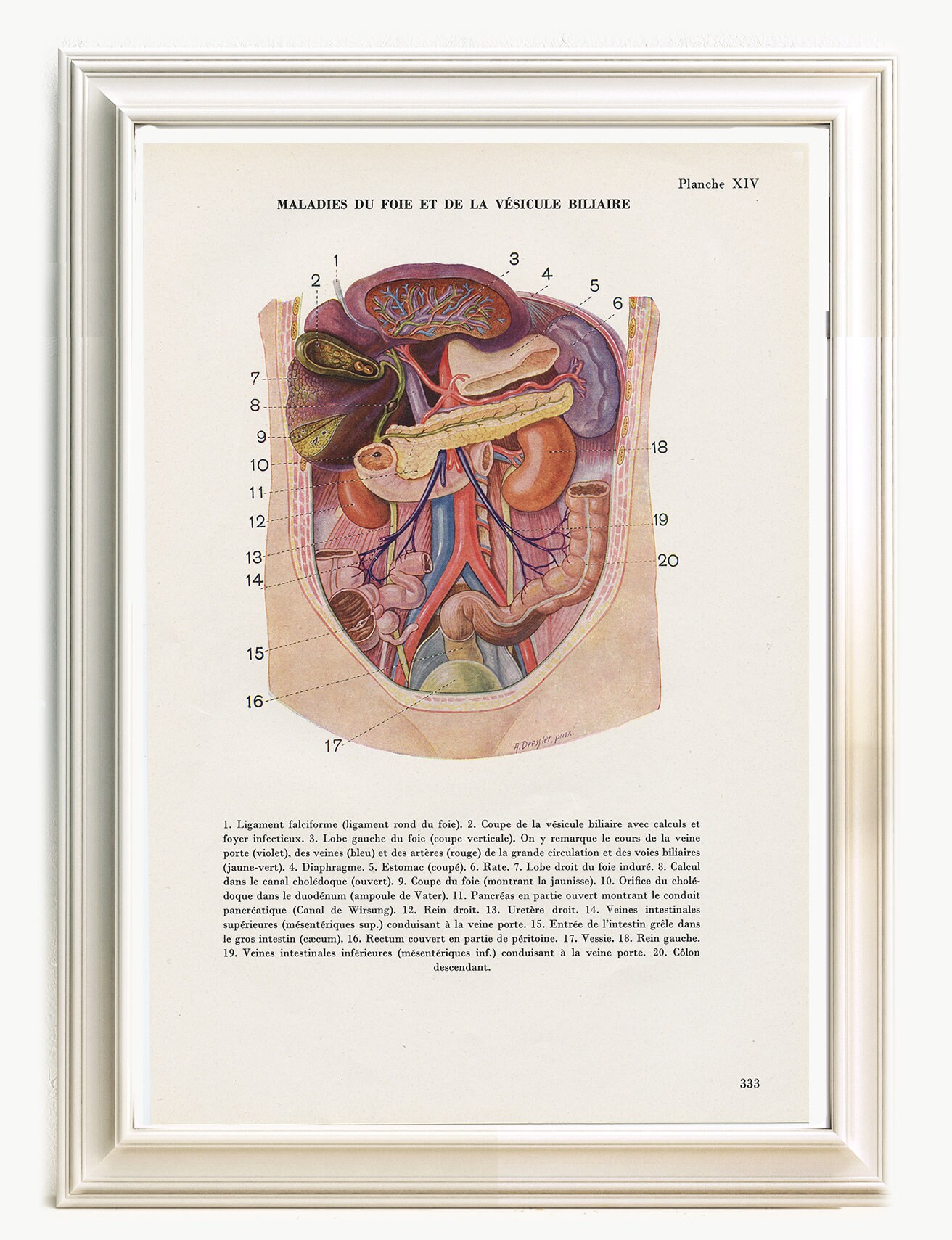 Gravure d'anatomie Vintage de 1950 Maladies Du Foie & Vésicule. Illustration Médicale Anatomique. Dé
