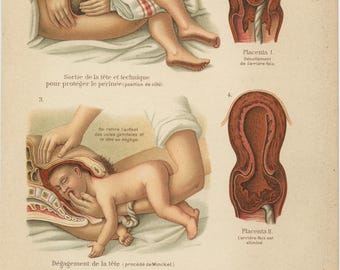 1903 Pregnancy & delivery anatomy print for medical student obgyn midwife gynaecologist  nurse office decor. Uterus Feminist art gift Baby