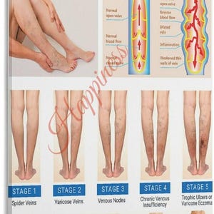 Varicose Veins Stages Chart, Vein Disease Anatomy Poster, Medical Office Decor (PDF Download)