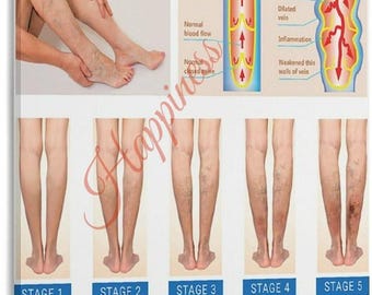 Varicose Veins Stages Chart, Vein Disease Anatomy Poster, Medical Office Decor (PDF Download)