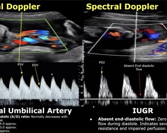 Doppler Ultrasound Cheat Sheet | OB MFM Quick Reference (Digital Download)