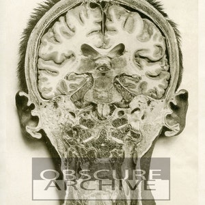 May include: A black and white anatomical illustration of a human head, showcasing a cross-section of the brain and skull. The image includes the text "OBSCURE ARCHIVE" and "PLANCHE XVII".