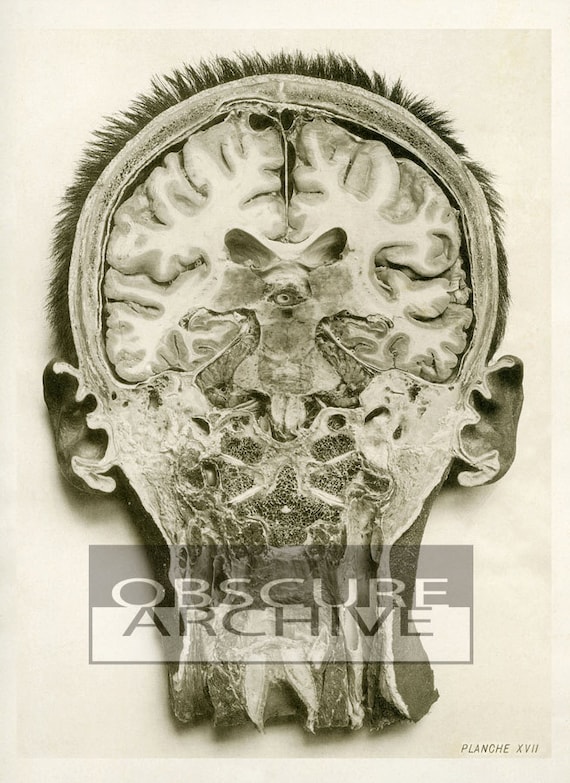 The Skull An Interior View Haunting Print Of A Bisected Head 1890s Medical Textbook Photo