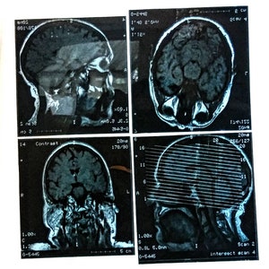 Könnte beinhalten: Vier schwarz-weiße medizinische Bilder eines menschlichen Gehirns, wahrscheinlich ein MRT- oder CT-Scan. Die Bilder zeigen Querschnitte des Gehirns aus verschiedenen Blickwinkeln mit sichtbaren anatomischen Details. Die Bilder sind auf weißem Hintergrund.