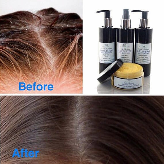 Scalp Serum Treatment For Scalp Eczema Seborrheic ...