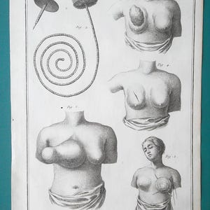 SURGERY Surgical Instruments for Breast Cancer Tumors Mastectomy  - 1763 Original DIDEROT Antique Print