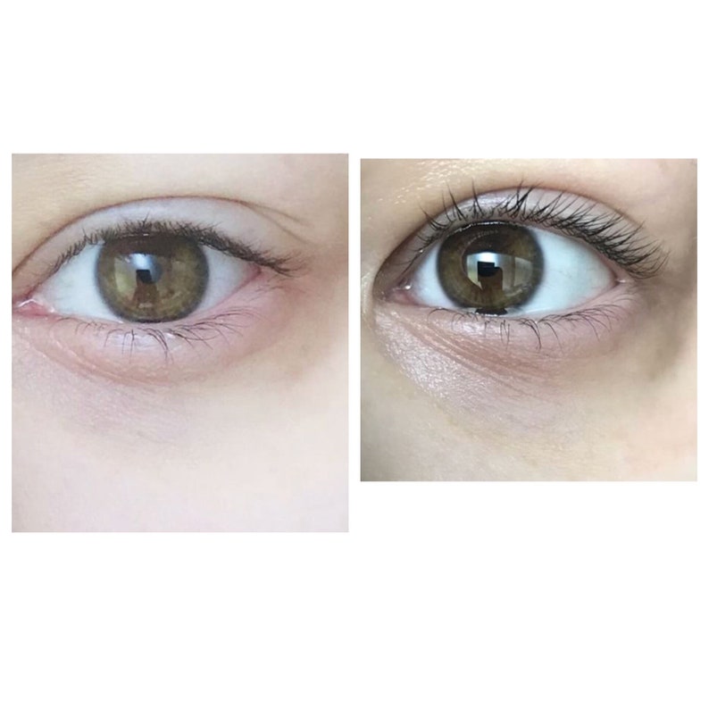 May include: A split image shows a close-up of an eye before and after a cosmetic treatment. The eye has brown irises, with visible eyelashes and skin around the eye. The before image shows dark circles under the eye, while the after image appears brighter.