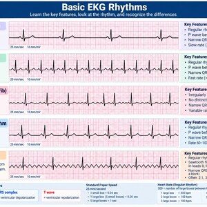 May include: An educational chart titled Basic EKG Rhythms displaying five heart rhythm strips: Sinus Bradycardia, Sinus Tachycardia, Atrial Fibrillation, Normal Sinus Rhythm, and Atrial Flutter. Each row includes rhythm data, key features, and rates.