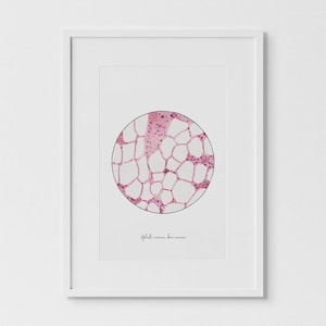 Anemia aplastica, midollo osseo, istologia, arte istologica, arte scientifica, sciart, arte biologica, stampa medica, stampa scientifica, stampa biologica