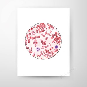 Sickle Cell Anemia, Science art, biology art, science gift,blood cell, laboratory,  cells,  blood, watercolor print, science print, med tech