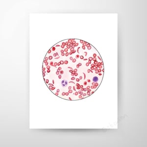 Sickle Cell Anemia, Science art, biology art, science gift,blood cell, laboratory,  cells,  blood, watercolor print, science print, med tech