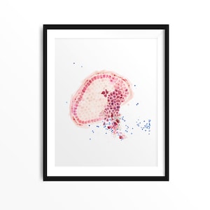 Invasive Ductal Carcinoma: Breast Cancer Watercolor Art Print Cancer Gift