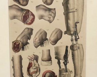Nicolas Henri Jacob pl. 83 Tome 6 Lithograph of Braces and Leg Prosthetic C. 1900