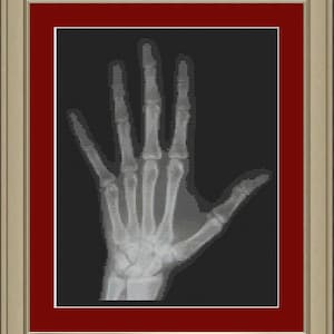 Könnte beinhalten: Ein Schwarzweiß-Röntgenbild einer Hand mit gespreizten Fingern.