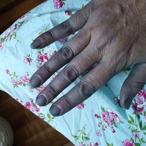 May include: A close-up of a hand with all five fingers stained a dark blue color. The hand is resting on a light blue fabric with a floral pattern.