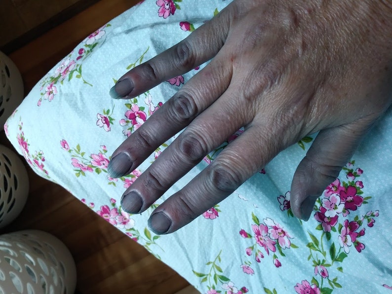 May include: A close-up of a hand with all five fingers stained a dark blue color. The hand is resting on a light blue fabric with a floral pattern.