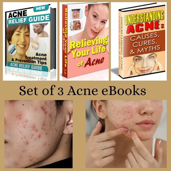 eBooks - Set of 3 Acne eBooks - acne prevention/treatment/tips/cures/myths/causes - skin care for acne - problem skin - skin health