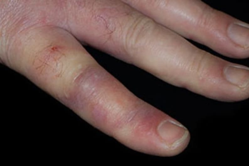 CHILBLAINS Homeopathy Cream for Frostbite CHILBLAINS Chill | Etsy